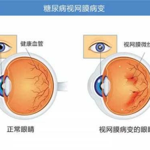 南召县城关镇卫生院：优化营商环境 持续开展眼底病筛查